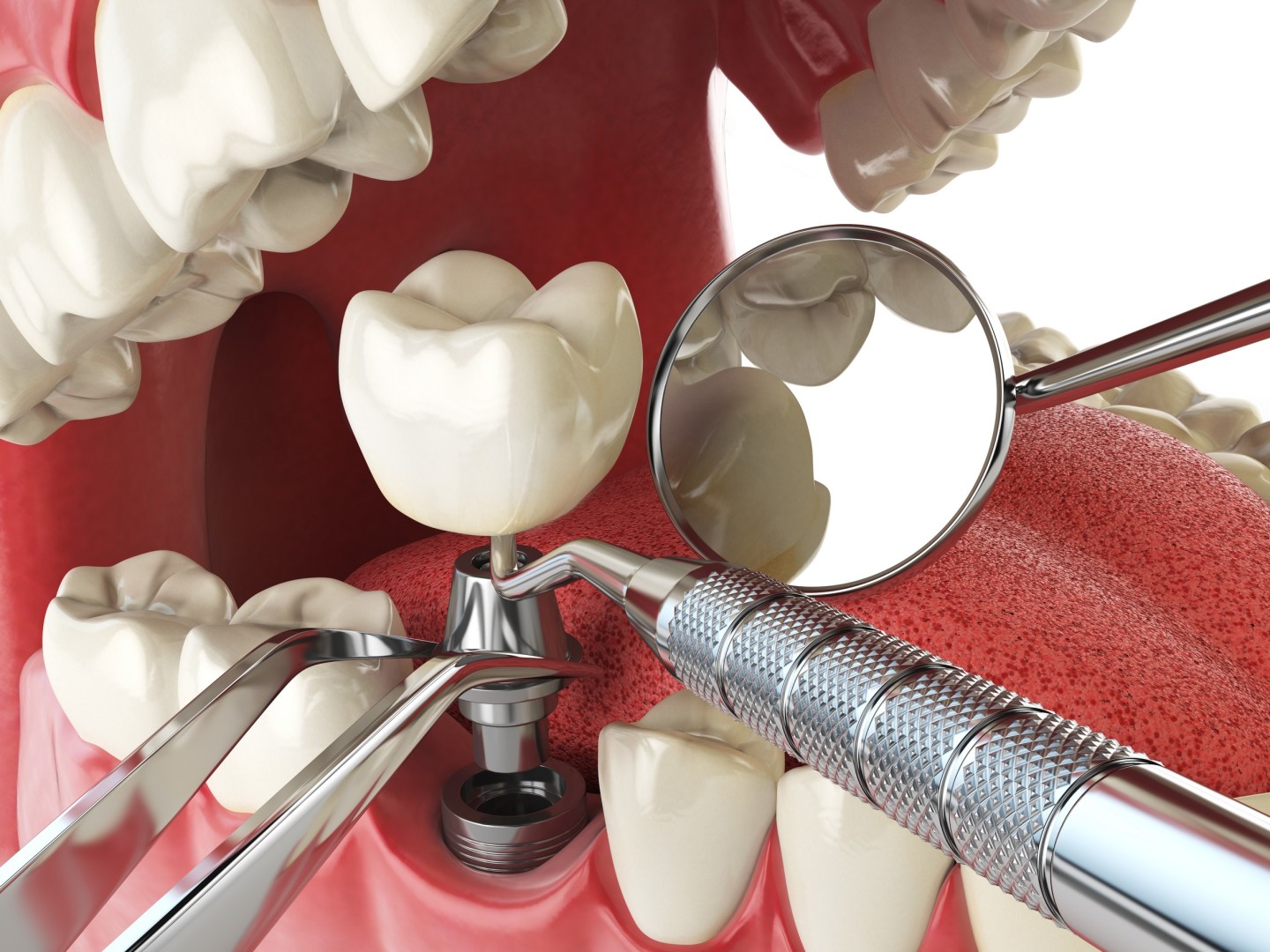 Implantologie dentaire